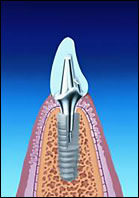 インプラント/歯のない部分に歯をつくる