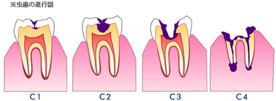 虫歯を放置した状態での進行の過程