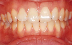 歯のホワイトニングの注意点