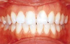 ホワイトニング治療済みの歯