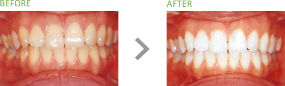 BEFORE AFTER