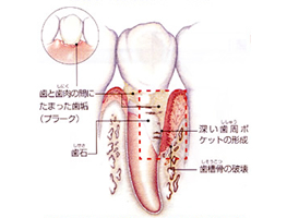 歯周病とは